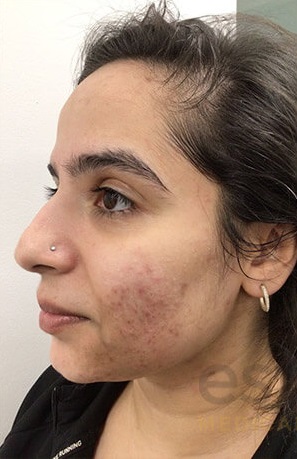 Before treatment